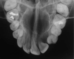 occlusal x-ray