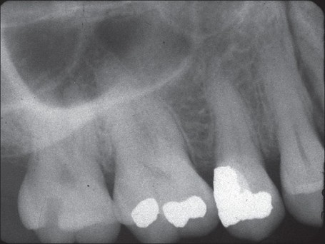 periapical x-ray