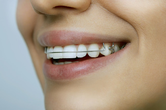 dental retainer