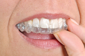 Clear dental aligners